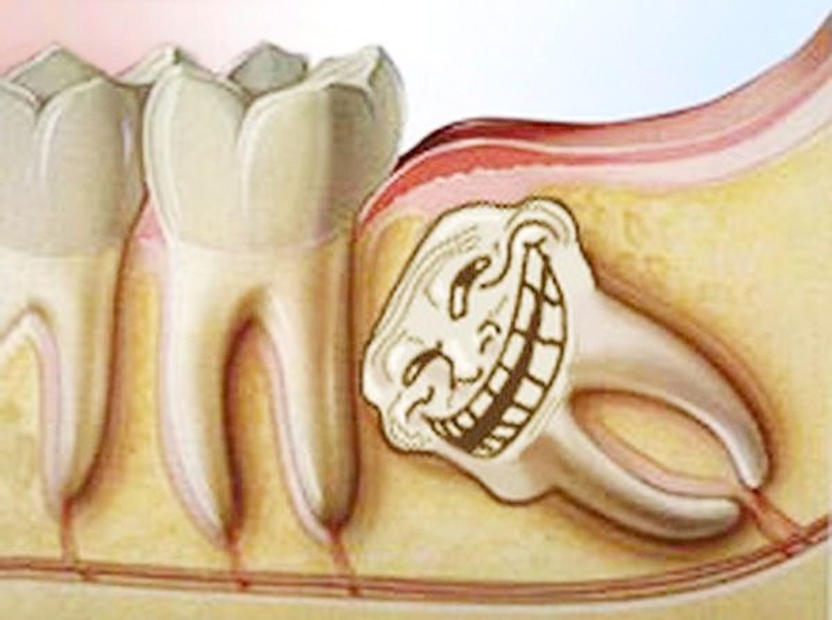 Why Having Wisdom Teeth Is Just Like Having A Bad College Roomate