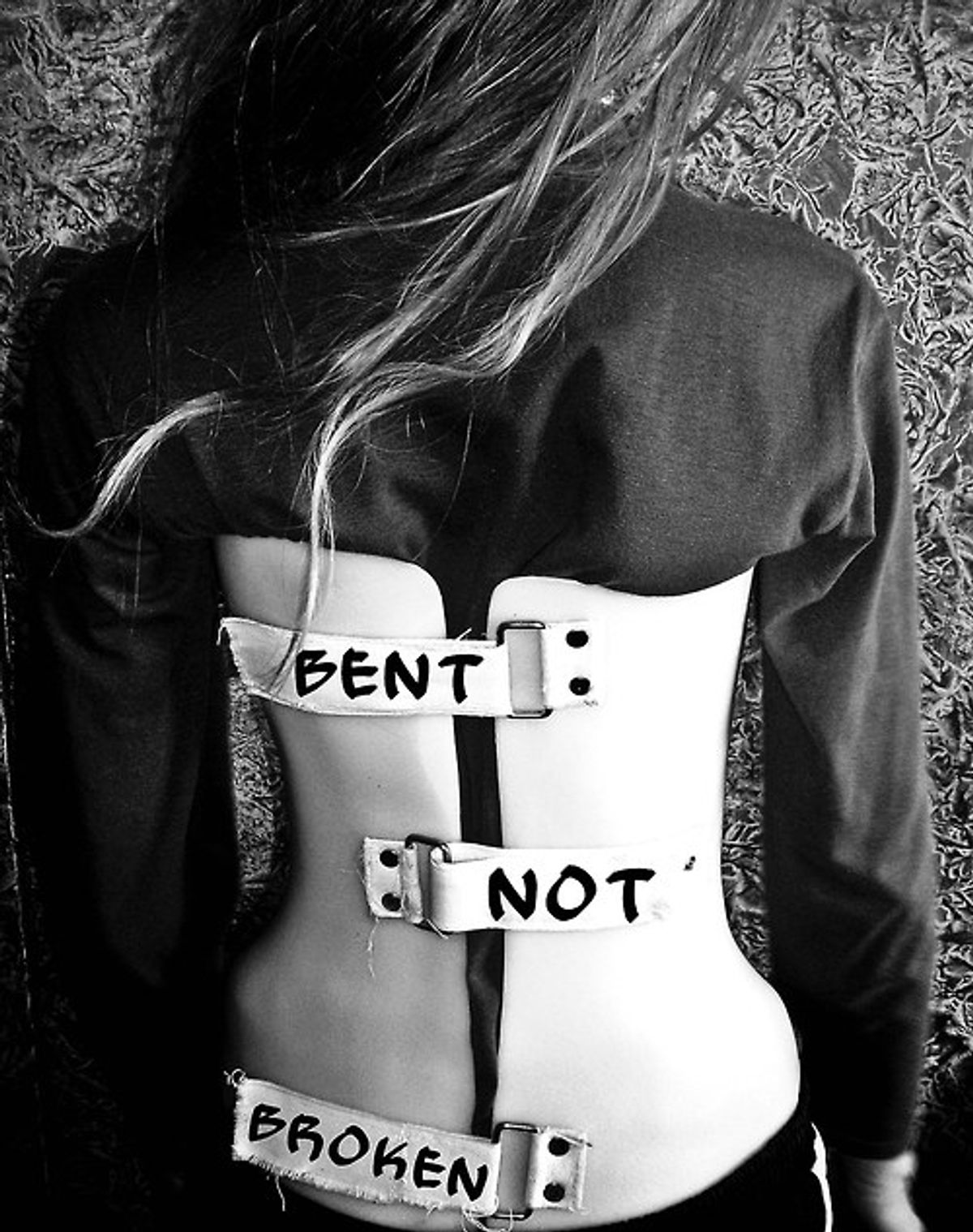 Bent Not Broken: How Scoliosis Has Changed My Life