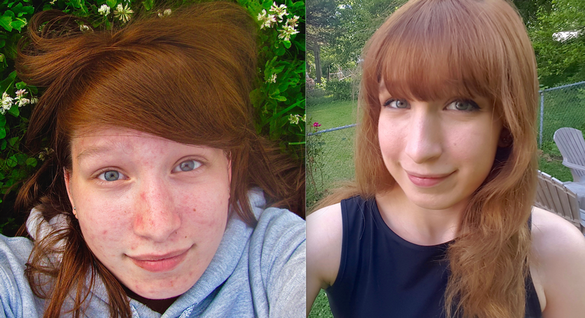 My Struggle With Acne And How It Affected My Confidence