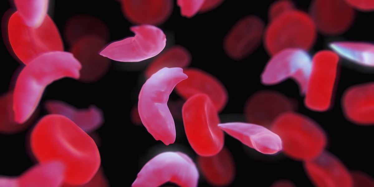 Sickle Cell Anemia