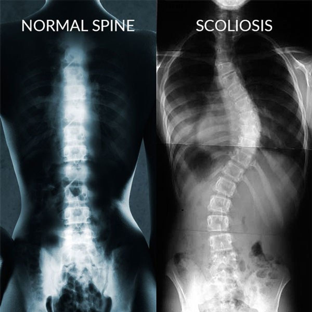 Scoliosis;