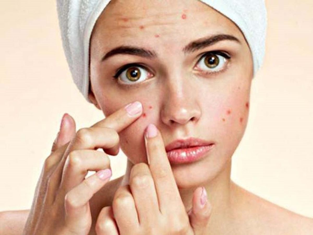 Why I'm Not Ashamed Of My Acne