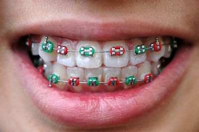 Tweens are making braces out of paper clips, rubber bands — and  predictably, it's damaging their teeth