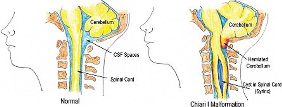 What is Arnold-Chiari Malformation?