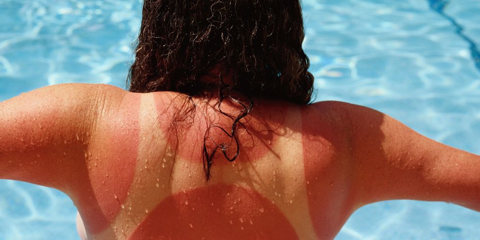 7 Struggles Those Who Easily Burn Will Understand