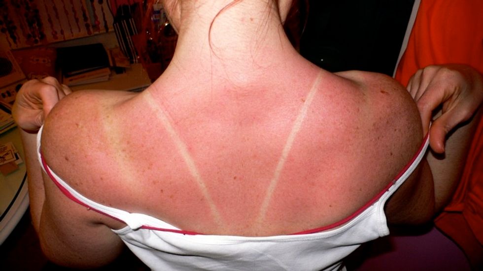 15 Thoughts Pale Girls Have When They Are Forever Sunburnt Instead Of Getting A Golden Glow