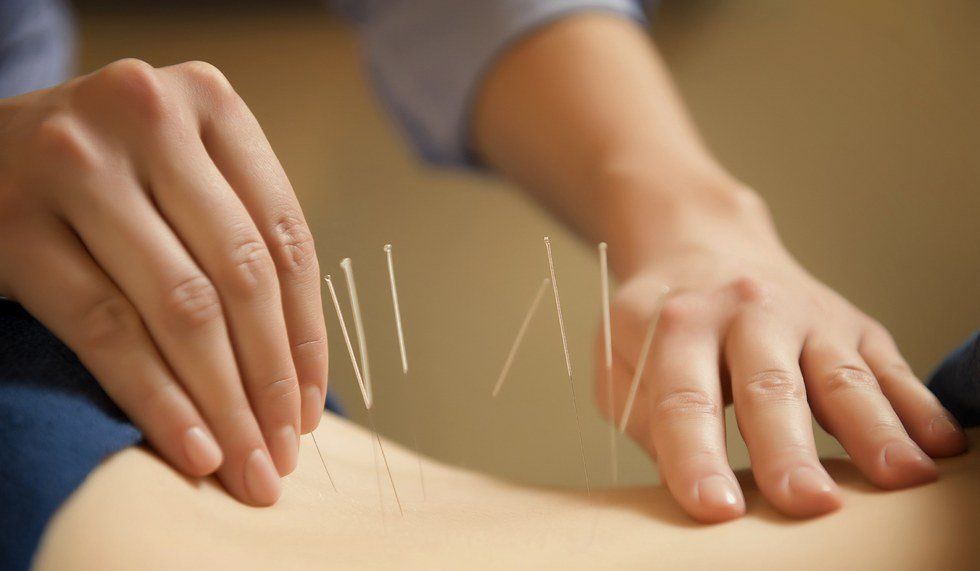 Discovering Acupuncture When You Grew Up In The World of Western Medicine