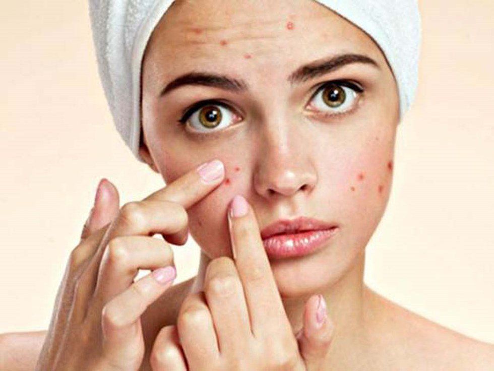 Why I'm Not Ashamed Of My Acne