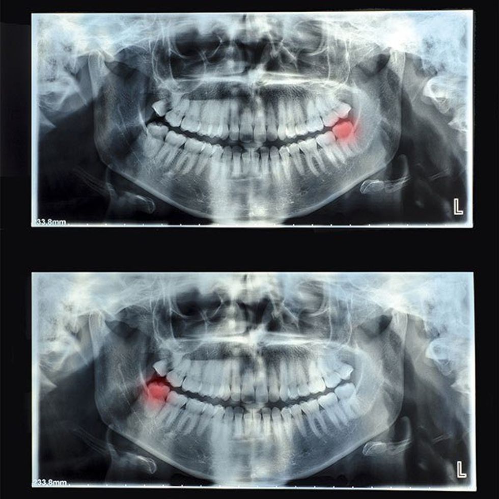 Wisdom Teeth