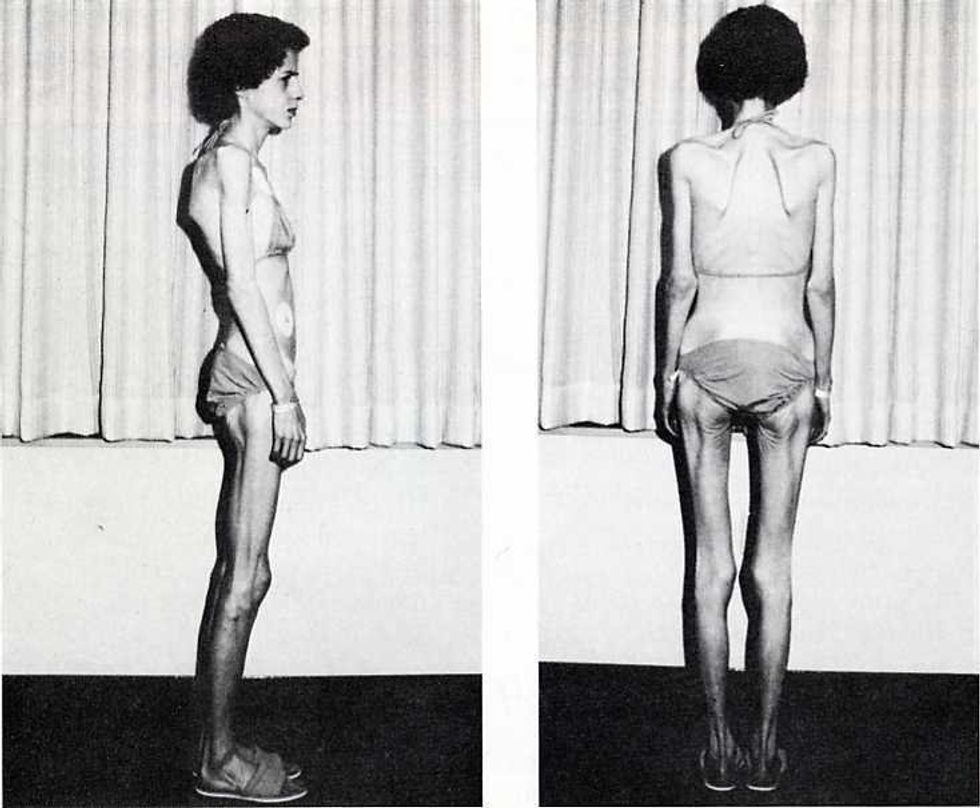 Anorexia Nervosa