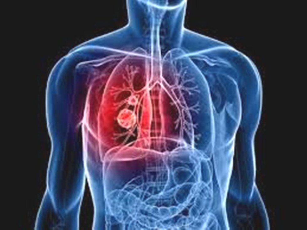 Living with a Pulmonary Embolism