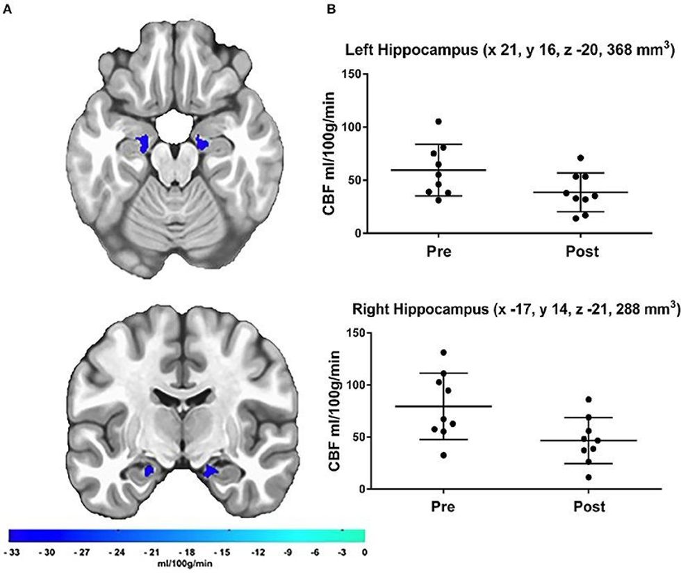 What Happens To Your Brain When You Don't Exercise For 10 Days?