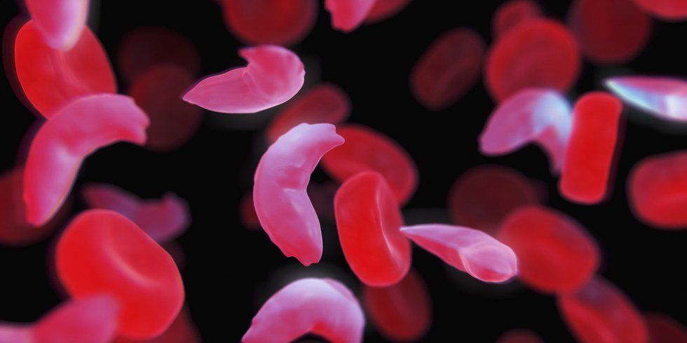 Sickle Cell Anemia