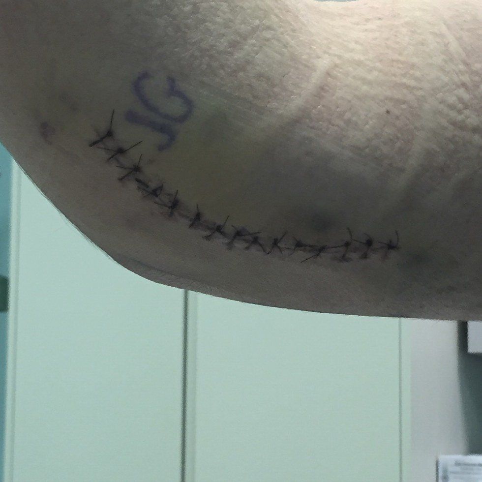 Tommy John Surgery Has Been Quite The Experience