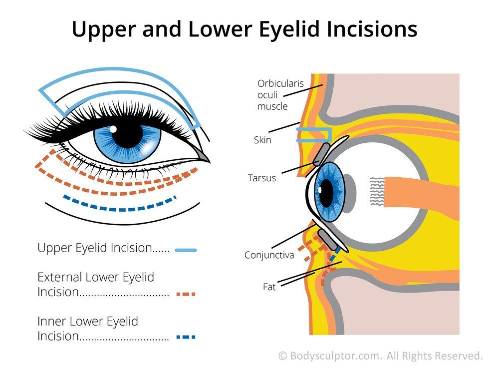 I Had My Eyelids Cut Open