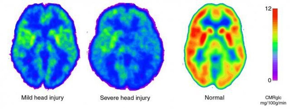 The Psychology Of A Concussion