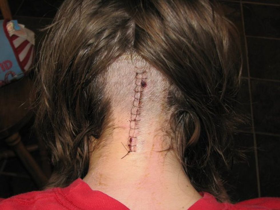 Living With Chiari Malformation: Part IV