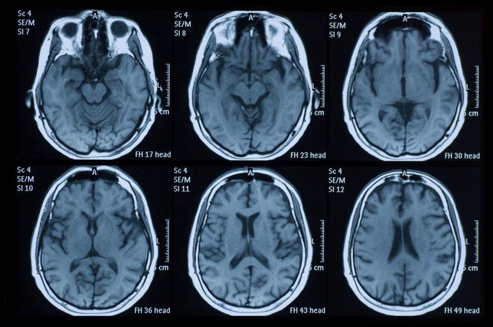 What Is Multiple Sclerosis?