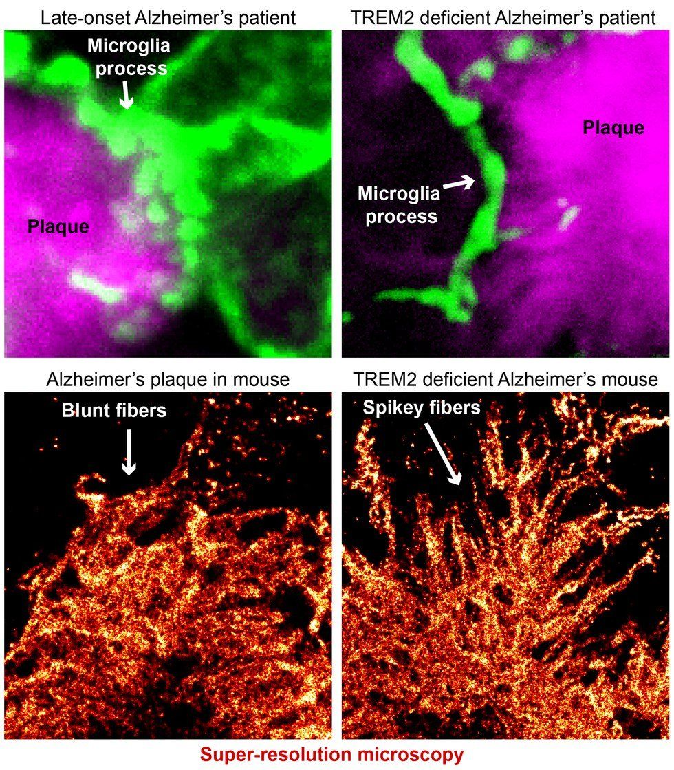 The Immune Cells: A Possible Solution To The Fight Against Alzheimer's