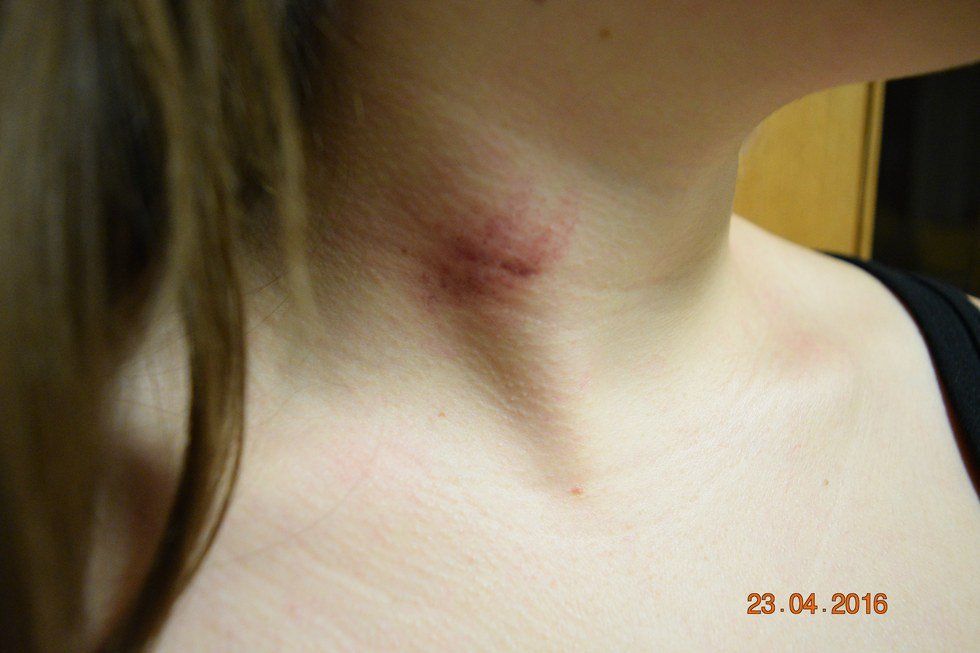 Why Are Hickeys So Unacceptable?