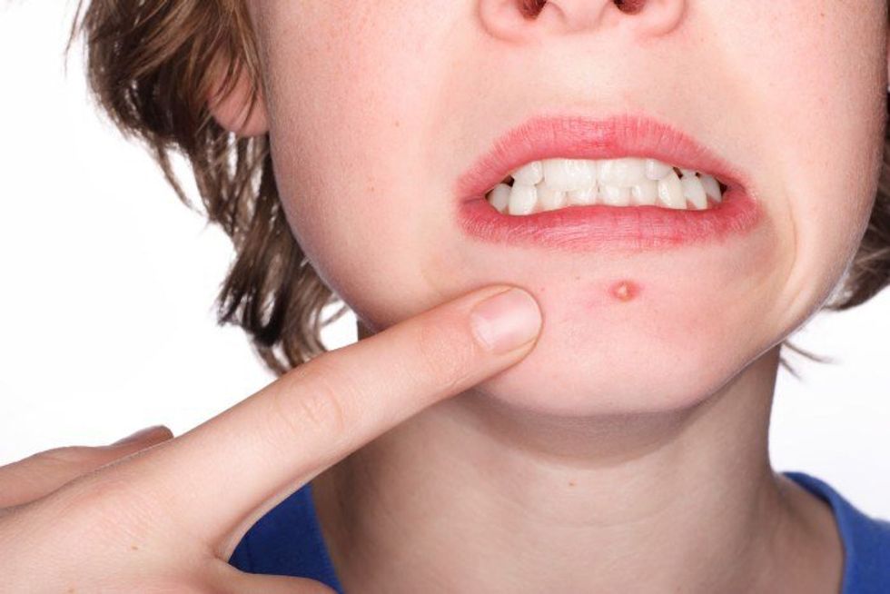 How I Finally Cured My Acne (And What My Dermatologist Didn't Tell Me)