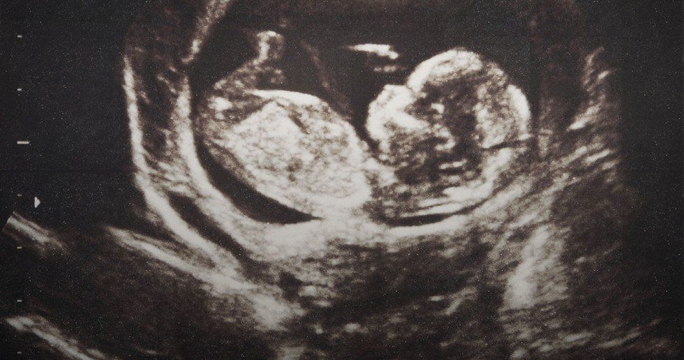 5 Reasons Why I Am Not Pro-Life