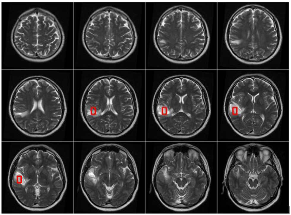 The 10 Stages Of Living With A Brain Tumor