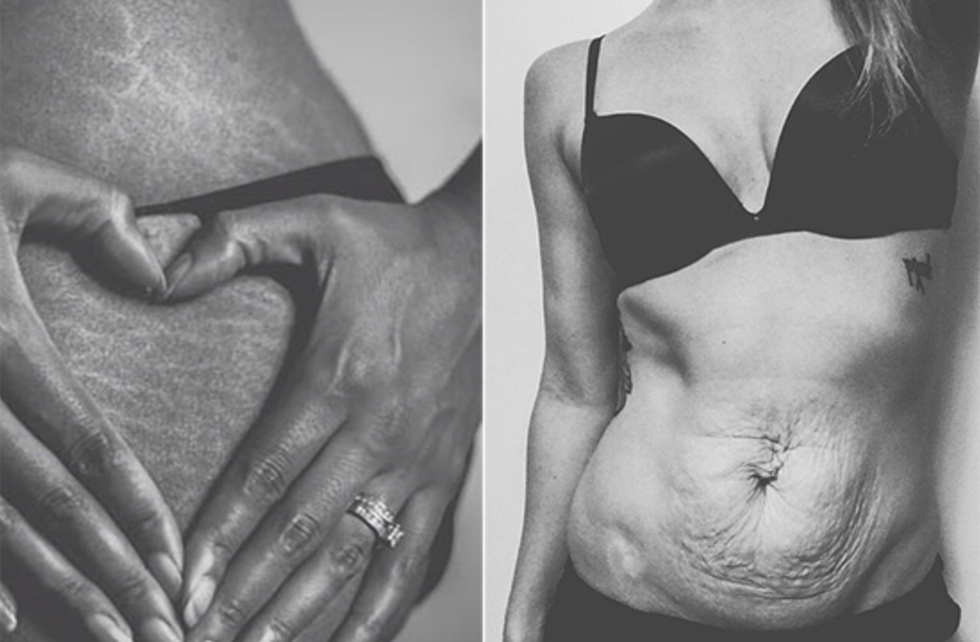 Stretch Marks: A Map of My Body's Journey