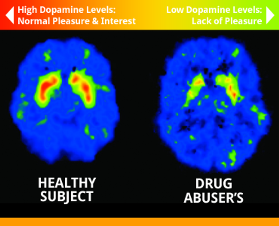 Addiction And The Brain: Why Addiction Is A Disease