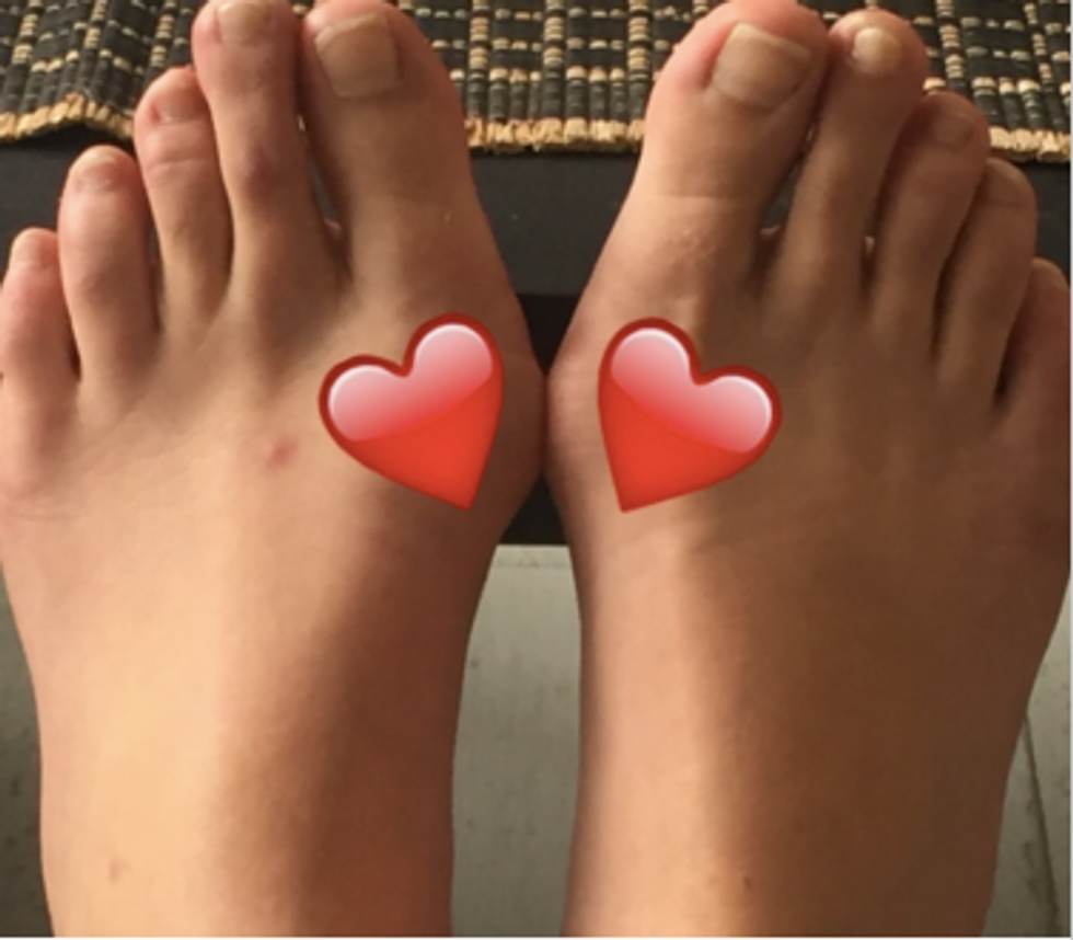 Ode To My Bunions